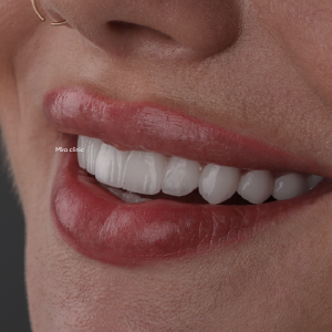 Dental Veneers