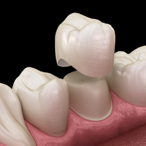 Dental Crowns