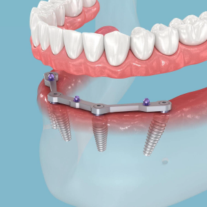 Импланты All-on-6