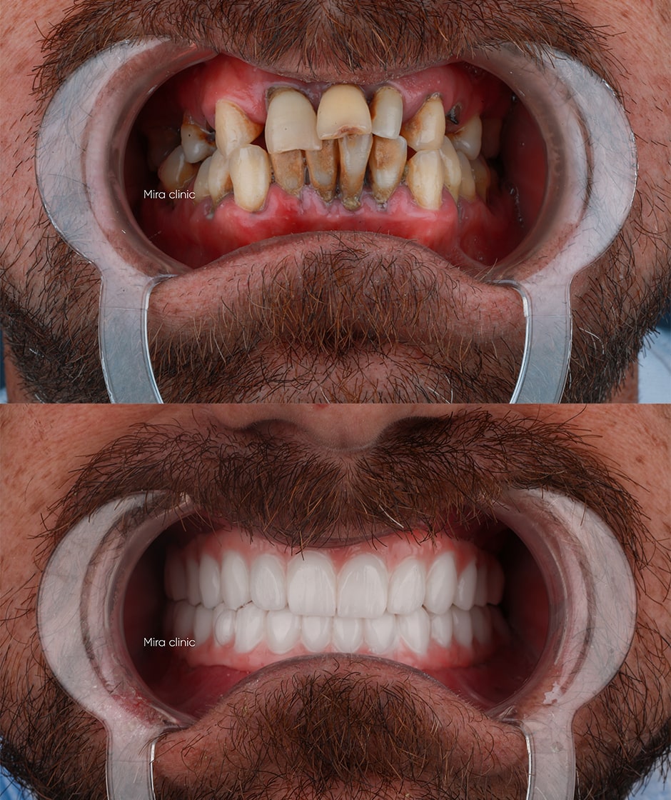 dental implant turkey 