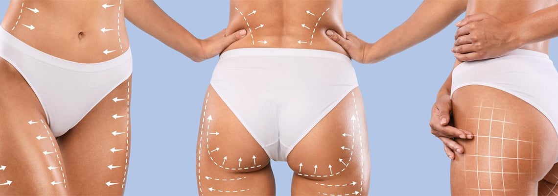 Combien de temps les implants fessiers (prothèses de fesses) durent-ils? Est-ce permanent?