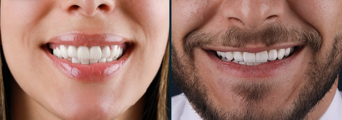 Hollywood Smile for Men vs Women in Turkey: How Gender Impacts Smile Design