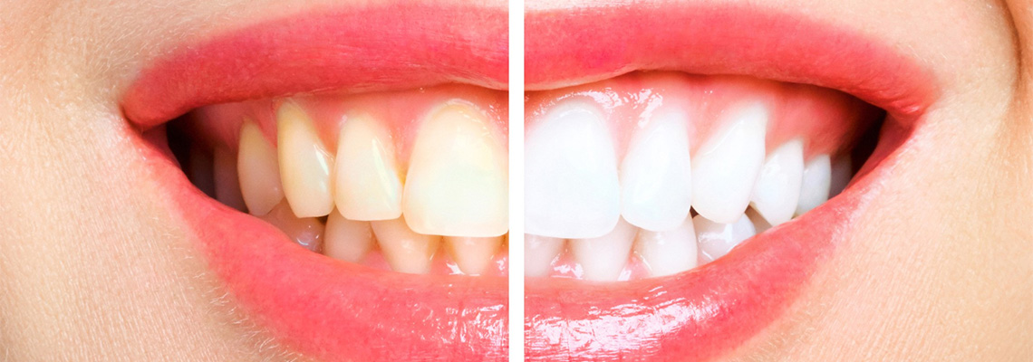 Emax Veneers: Pros and Cons