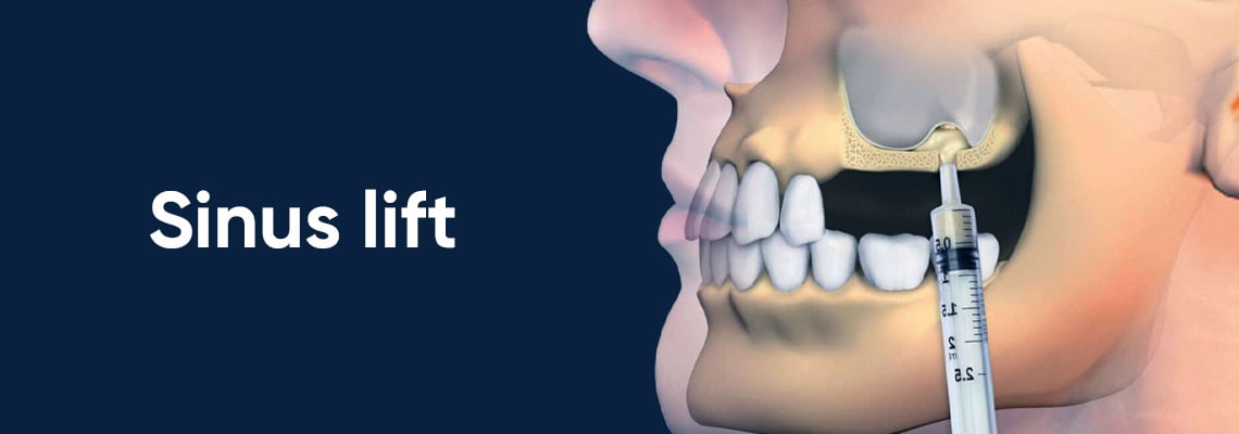 Sinus Lift in Turkey: Procedure, Types, Recovery, and Cost