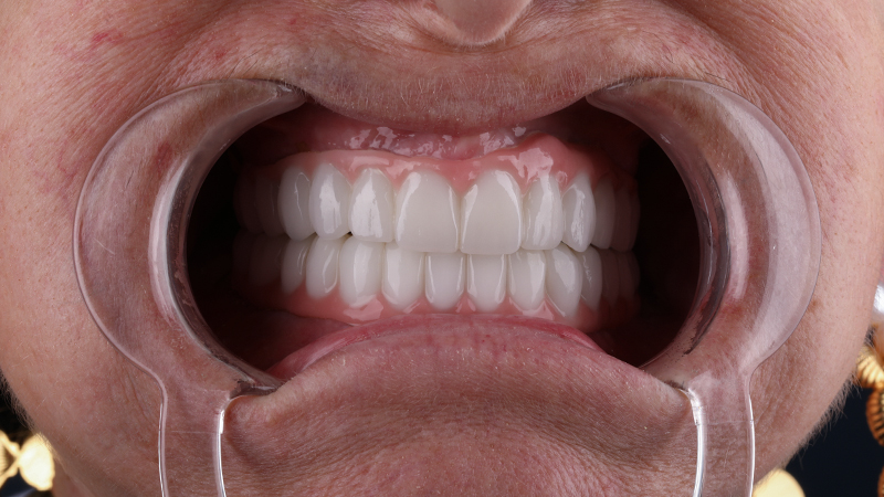 إجراء ابتسامة هوليوود في تركيا 2026 | كل ما تحتاج أن تعرفه