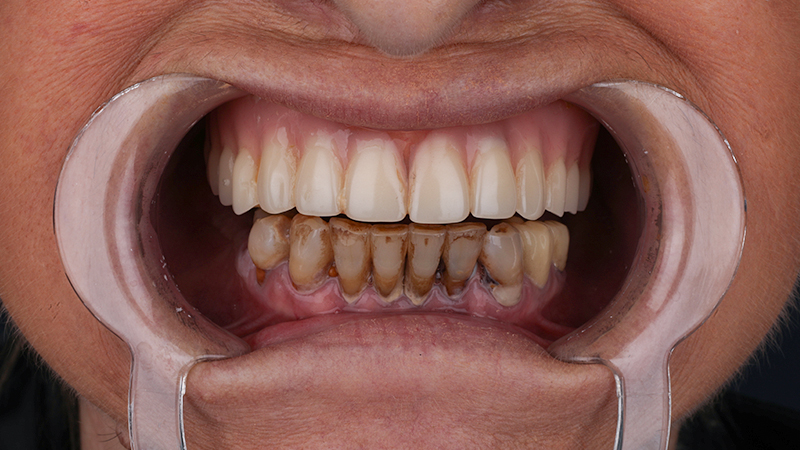 إجراء ابتسامة هوليوود في تركيا 2026 | كل ما تحتاج أن تعرفه