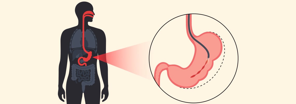 Endoscopic Sleeve Gastroplasty in Turkey