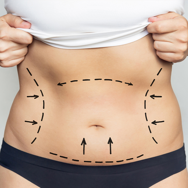 Top 12 Tummy Tuck Recovery Tips (2023)