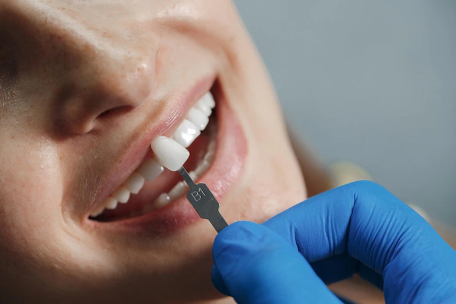 Avantages et inconvénients des facettes dentaires, les patients donnent  leur avis