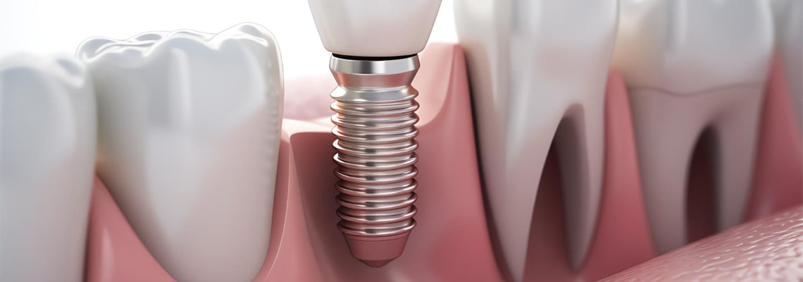 Hypertension and Dental Implants: Can I get dental implants with high blood pressure?