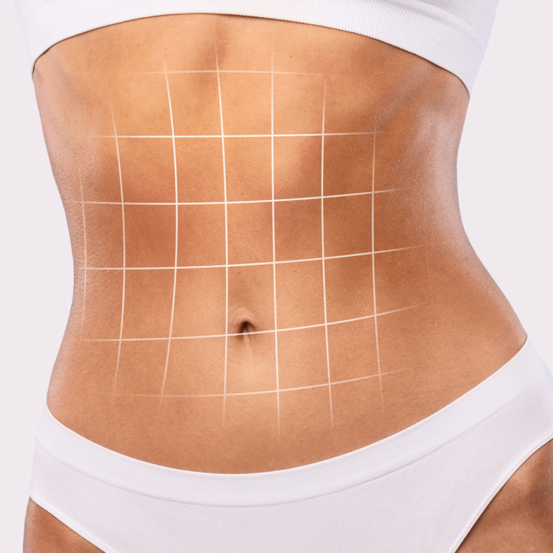 Mira-clinic  Tummy tuck recovery: recovery stages, post-operative  instructions, and side effects.